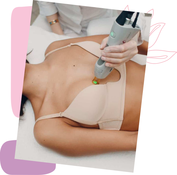 Laser Removal for Areola Beautification: Enhancing Confidence and Comfort